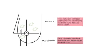 carcinoma-ductal-in-situ-cris-ca-mama-oncologia-pptx
