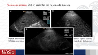 Técnicas de cribado: USG en pacientes con riesgo cada 6 meses.
 