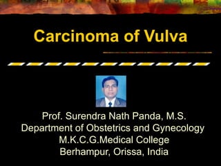 Carcinoma of Vulva Prof. Surendra Nath Panda, M.S. Department of Obstetrics and Gynecology  M.K.C.G.Medical College Berhampur, Orissa, India 
