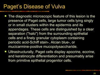 Paget ’ s Disease of Vulva The diagnostic microscopic feature of this lesion is the presence of Paget cells, large tumor cells lying singly or in small clusters within the epidermis and its appendages. These cells are distinguished by a clear separation ("halo") from the surrounding epithelial cells and a finely granular cytoplasm containing periodic acid-Schiff stain-, Alcian blue-, or mucicarmine-positive mucopolysaccharide.  Ultrastructurally, Paget cells display apocrine, eccrine, and keratinocyte differentiation and presumably arise from primitive epithelial progenitor cells.  