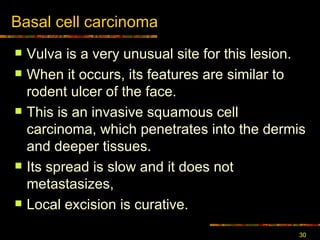 Basal cell carcinoma Vulva is a very unusual site for this lesion. When it occurs, its features are similar to rodent ulcer of the face. This is an invasive squamous cell carcinoma, which penetrates into the dermis and deeper tissues. Its spread is slow and it does not metastasizes, Local excision is curative. 
