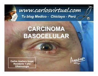 CARCINOMA
           BASOCELULAR



Carlos Azañero Inope
  Residente 1 año
    Oftalmología       Dr. Carlos Augusto Azañero Inope
                             www.carlosvirtual.com
 