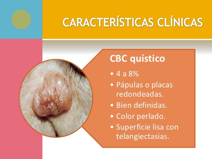 Carcinoma basocelular