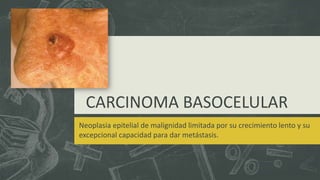 CARCINOMA BASOCELULAR
Neoplasia epitelial de malignidad limitada por su crecimiento lento y su
excepcional capacidad para dar metástasis.
 