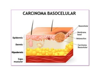 Carcinoma Basocelular PPTX carcinoma-basocelular-pptx
