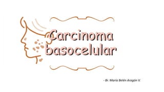 Carcinoma
basocelular
- Br. María Belén Aragón V.
 