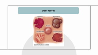 Ulcus Rodems Comprehensive Overview of Basal Cell Carcinoma: Diagnosis, Risk Factors ...