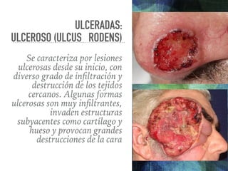 ULCERADAS:
ULCEROSO (ULCUS RODENS)
Se caracteriza por lesiones
ulcerosas desde su inicio, con
diverso grado de inﬁltración...