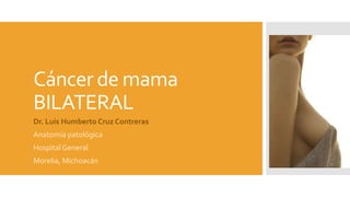 Cáncer de mama
BILATERAL
Dr. Luis Humberto Cruz Contreras
Anatomía patológica
Hospital General
Morelia, Michoacán
 