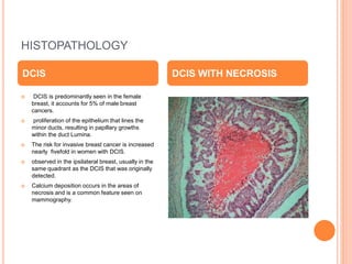 Carcinoma breast and its management (1).pptx