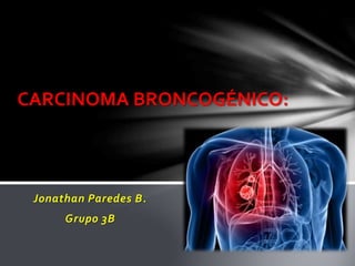 Jonathan Paredes B.
Grupo 3B
CARCINOMA BRONCOGÉNICO:
 