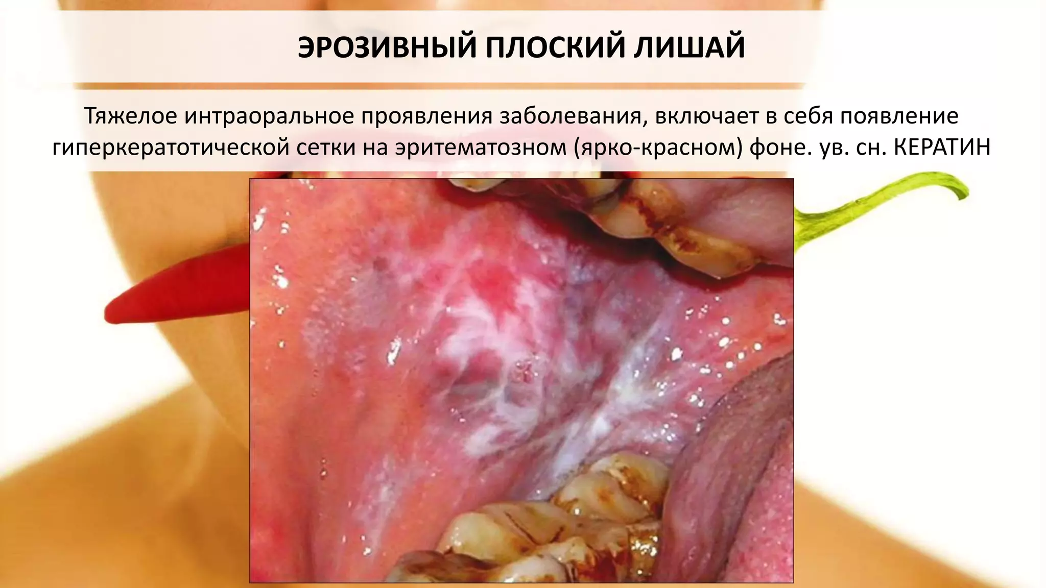 ЭРОЗИВНЫЙ ПЛОСКИЙ ЛИШАЙ
Тяжелое интраоральное проявления заболевания, включает в себя появление
гиперкератотической сетки на эритематозном (ярко-красном) фоне. ув. сн. КЕРАТИН
 