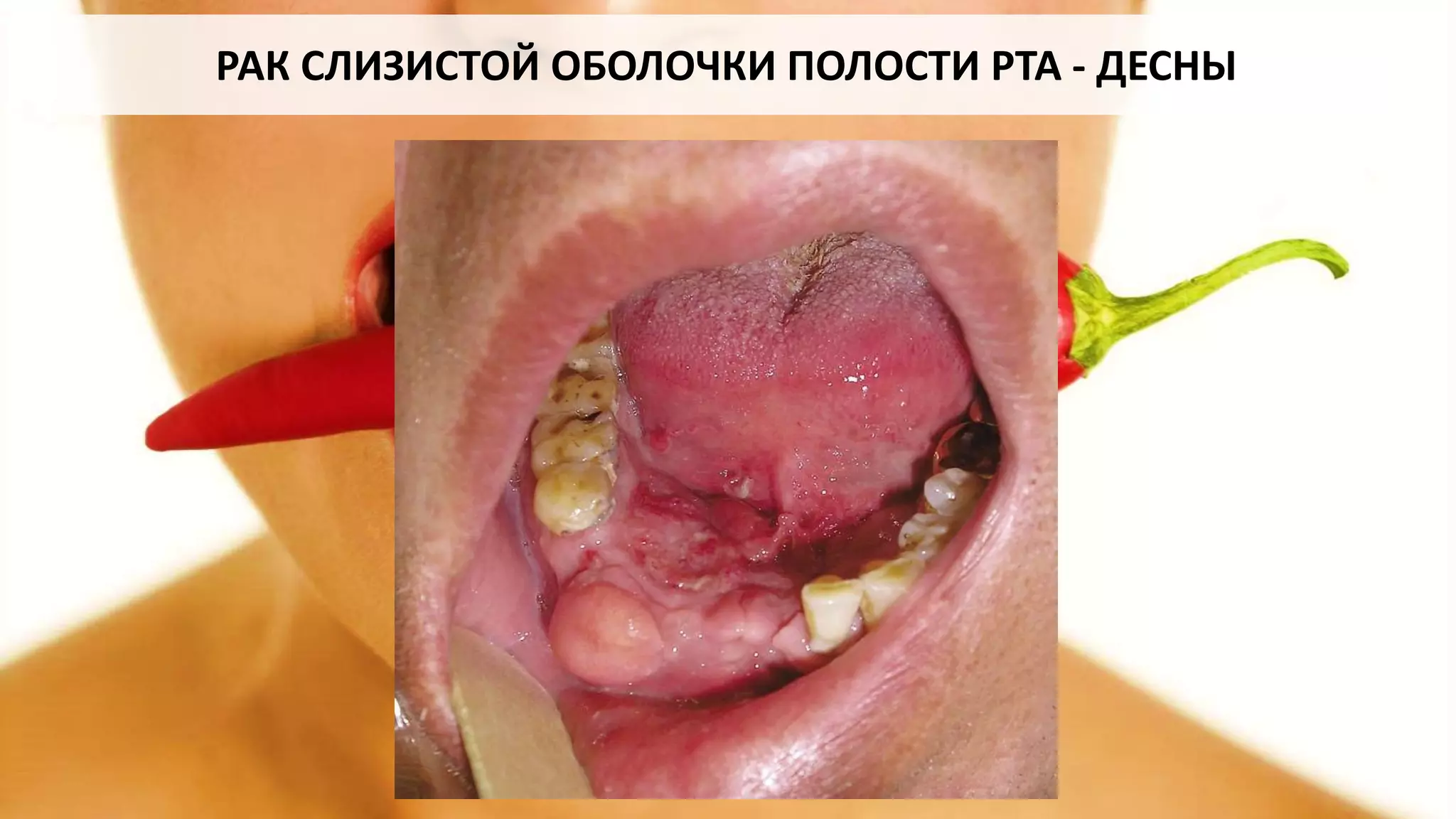 РАК СЛИЗИСТОЙ ОБОЛОЧКИ ПОЛОСТИ РТА - ДЕСНЫ
 