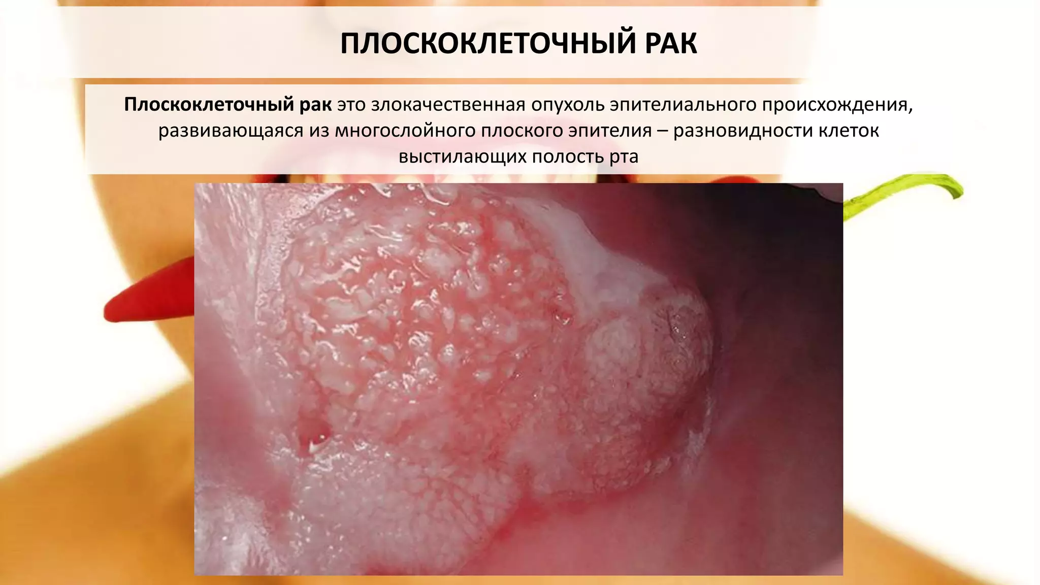 ПЛОСКОКЛЕТОЧНЫЙ РАК
Плоскоклеточный рак это злокачественная опухоль эпителиального происхождения,
развивающаяся из многослойного плоского эпителия – разновидности клеток
выстилающих полость рта
 