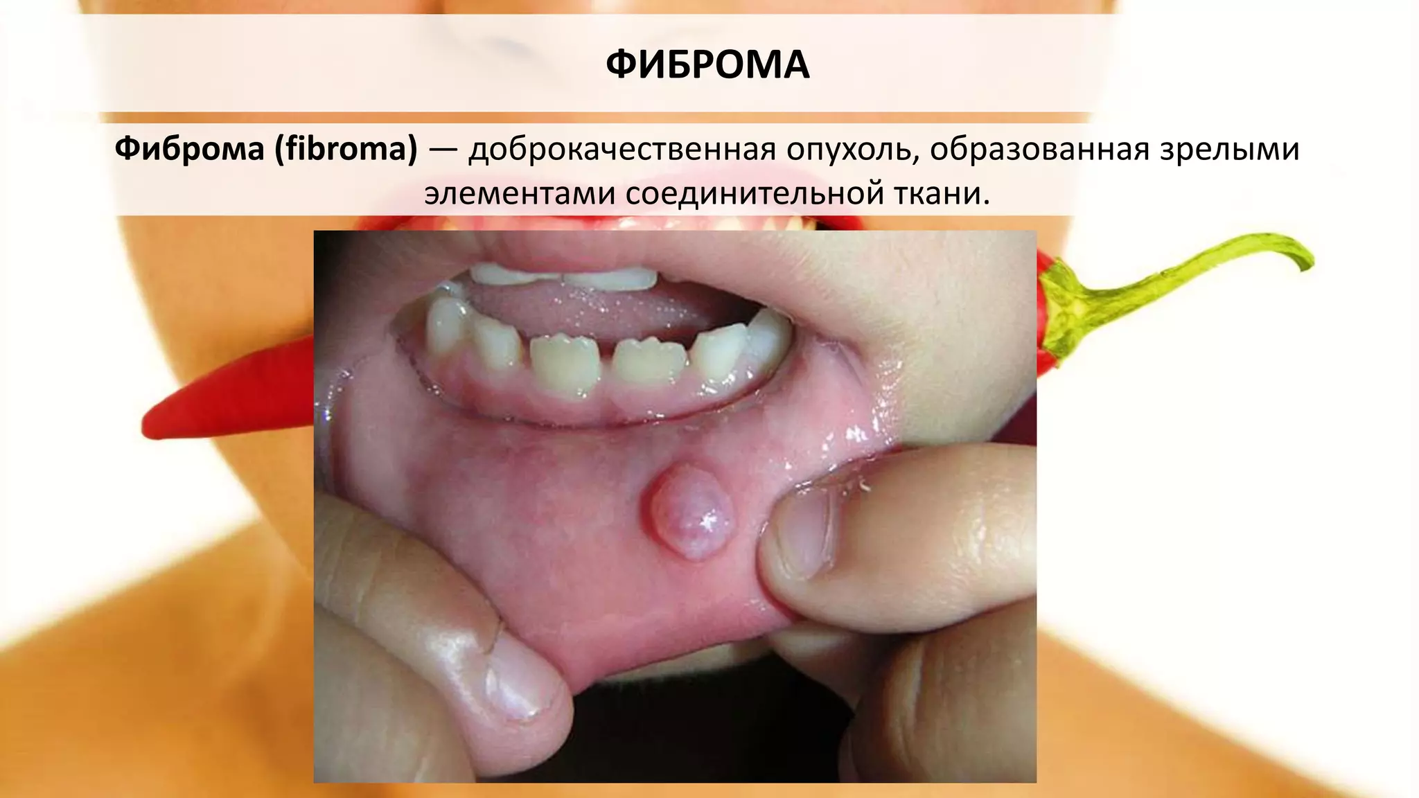 ФИБРОМА
Фиброма (fibroma) — доброкачественная опухоль, образованная зрелыми
элементами соединительной ткани.
 