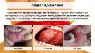 Рак слизистой полости рта - доброкачественная и злокачественная | PPT