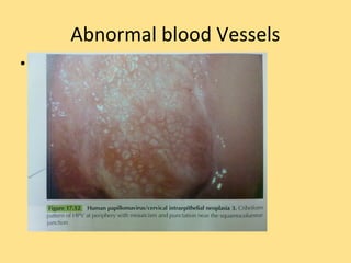 Abnormal blood Vessels
• Figure
 
