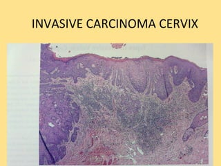 INVASIVE CARCINOMA CERVIX
 