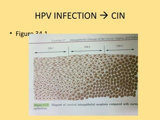 HPV INFECTION  CIN
• Figure 34.1
 