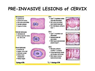 PRE-INVASIVE LESIONS of CERVIX
 