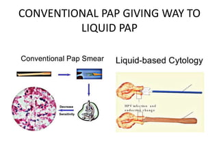 CONVENTIONAL PAP GIVING WAY TO
LIQUID PAP
 