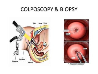 COLPOSCOPY & BIOPSY
 