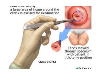 CONE BIOPSY
 