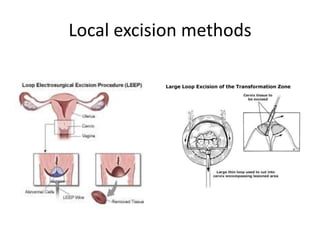 Local excision methods
 