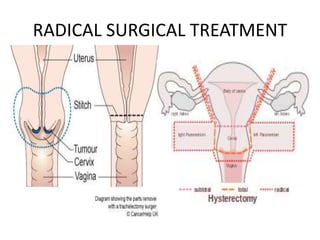 RADICAL SURGICAL TREATMENT
 