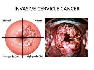 INVASIVE CERVICLE CANCER
 