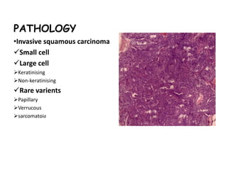 PATHOLOGY
•Invasive squamous carcinoma
Small cell
Large cell
Keratinising
Non-keratinising
Rare varients
Papillary
Verrucous
sarcomatoid
 