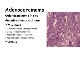 Adenocarcinoma
•Adenocarcinoma in situ
•Invasive adenocarcinoma
Mucinous
Minimal deviation adenocarcinoma
Glassy cell adenocarcinoma
Adenoid basal adenocarcinoma
Adenoid cystic adenocarcinoma
Serous
 