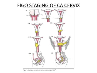 FIGO STAGING OF CA CERVIX
 