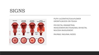 SIGNS
PS/PV-ULCERATIVE/CAULIFLOWER
GROWTH,BLEEDS ON TOUGH
PER RECTAL-PARAMETRIAL
INVOLVEMENT,RECTOVAGINAL OR RECTAL
MUCOSA INVOLVEMENT
PALPABLE INGUINAL NODES
 