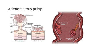 Adenomatous polyp
 