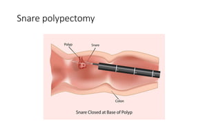 Snare polypectomy
 