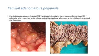 Familial adenomatous polyposis
• Familial adenomatous polyposis (FAP) is defined clinically by the presence of more than 100
colorectal adenomas, but is also characterized by duodenal adenomas and multiple extraintestinal
manifestations
 