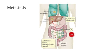 Metastasis
 