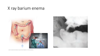 X ray barium enema
 