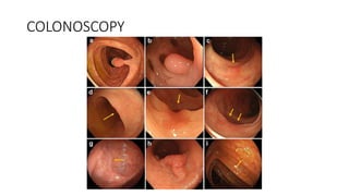 COLONOSCOPY
 