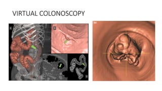 VIRTUAL COLONOSCOPY
 