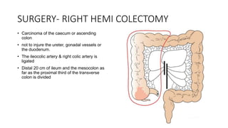 SURGERY- RIGHT HEMI COLECTOMY
• Carcinoma of the caecum or ascending
colon
• not to injure the ureter, gonadal vessels or
the duodenum.
• The ileocolic artery & right colic artery is
ligated
• Distal 20 cm of ileum and the mesocolon as
far as the proximal third of the transverse
colon is divided
 