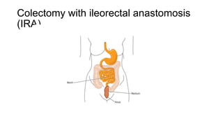 Colectomy with ileorectal anastomosis
(IRA)
 