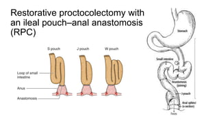 Restorative proctocolectomy with
an ileal pouch–anal anastomosis
(RPC)
 