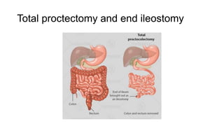 Total proctectomy and end ileostomy
 