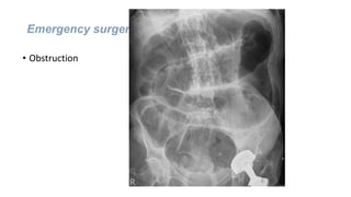 Emergency surgery
• Obstruction
 