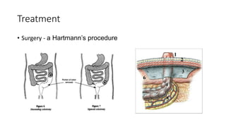 Treatment
• Surgery - a Hartmann’s procedure
 