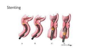 Stenting
 