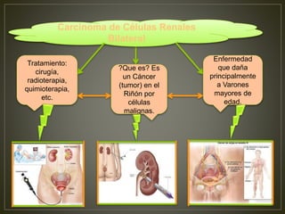 Carcinoma de Células Renales 
Bilateral 
?Que es? Es 
un Cáncer 
(tumor) en el 
Riñón por 
células 
malignas. 
Enfermedad 
que daña 
principalmente 
a Varones 
mayores de 
edad. 
Tratamiento: 
cirugía, 
radioterapia, 
quimioterapia, 
etc. 
