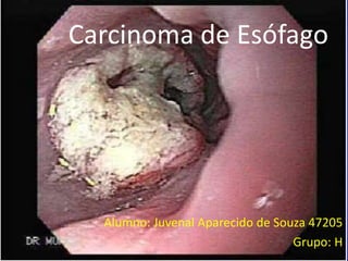 Carcinoma de Esófago
Alumno: Juvenal Aparecido de Souza 47205
Grupo: H
 